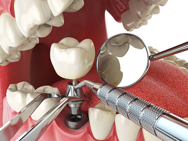 Best Chipped Tooth Repair Near Me  in Harrisonville, MO
